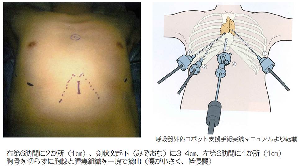 漏斗胸について漏斗胸・胸郭変形なら松山笠置記念心臓血管病院