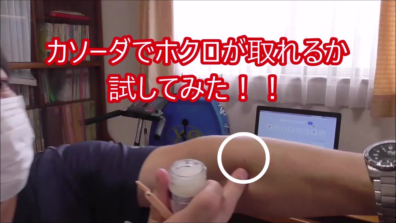 カソーダを使ってほくろ除去は出来る？使い方や作り方を詳しく紹介ほくろの知識、ほくろ除去の知識Ｑ&Ａ