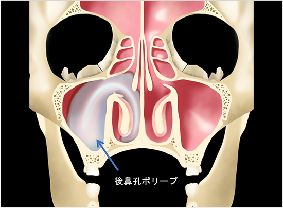 見てわかる鼻の病気 耳鼻咽喉科内藤クリニック