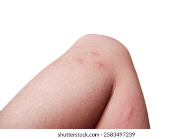 猫のノミは人間にうつる！ノミに刺されたときの症状や対処法を解説ぽちたま薬局スタッフブログ