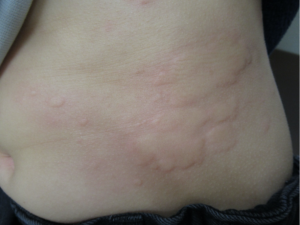 環状紅斑・水前寺皮フ科医院熊本市の皮膚科・形成外科・アレルギー科