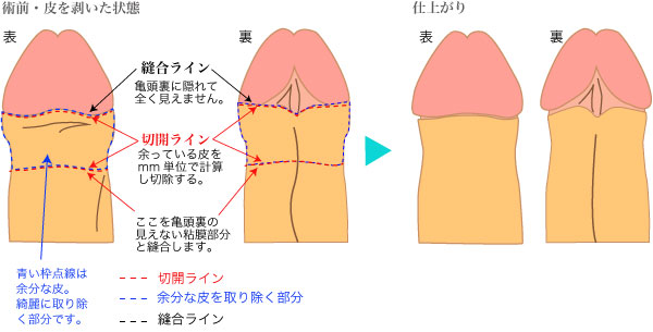 包茎｜神戸市東灘区 摂津本山｜いしむら腎泌尿器科クリニック