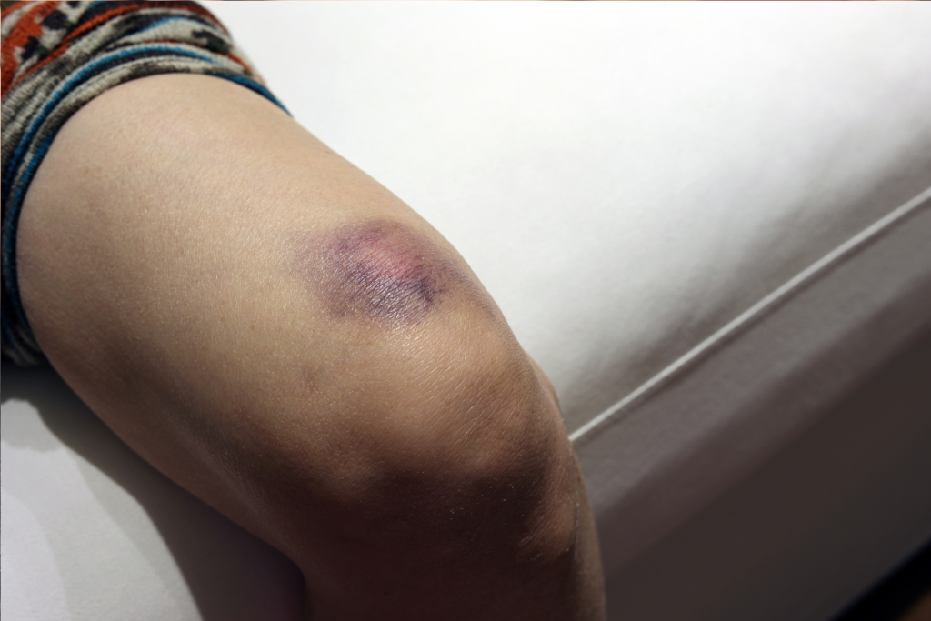 身に覚えのないあざが黄色い？考えられる原因と対処法を解説「さかぐち整骨院 -枚方市-」枚方市で口コミ評価NO.1