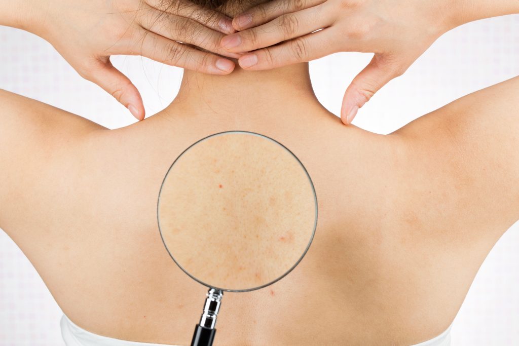 背中にきびの写真素材写真素材なら「写真AC」無料 フリー ダウンロードOK