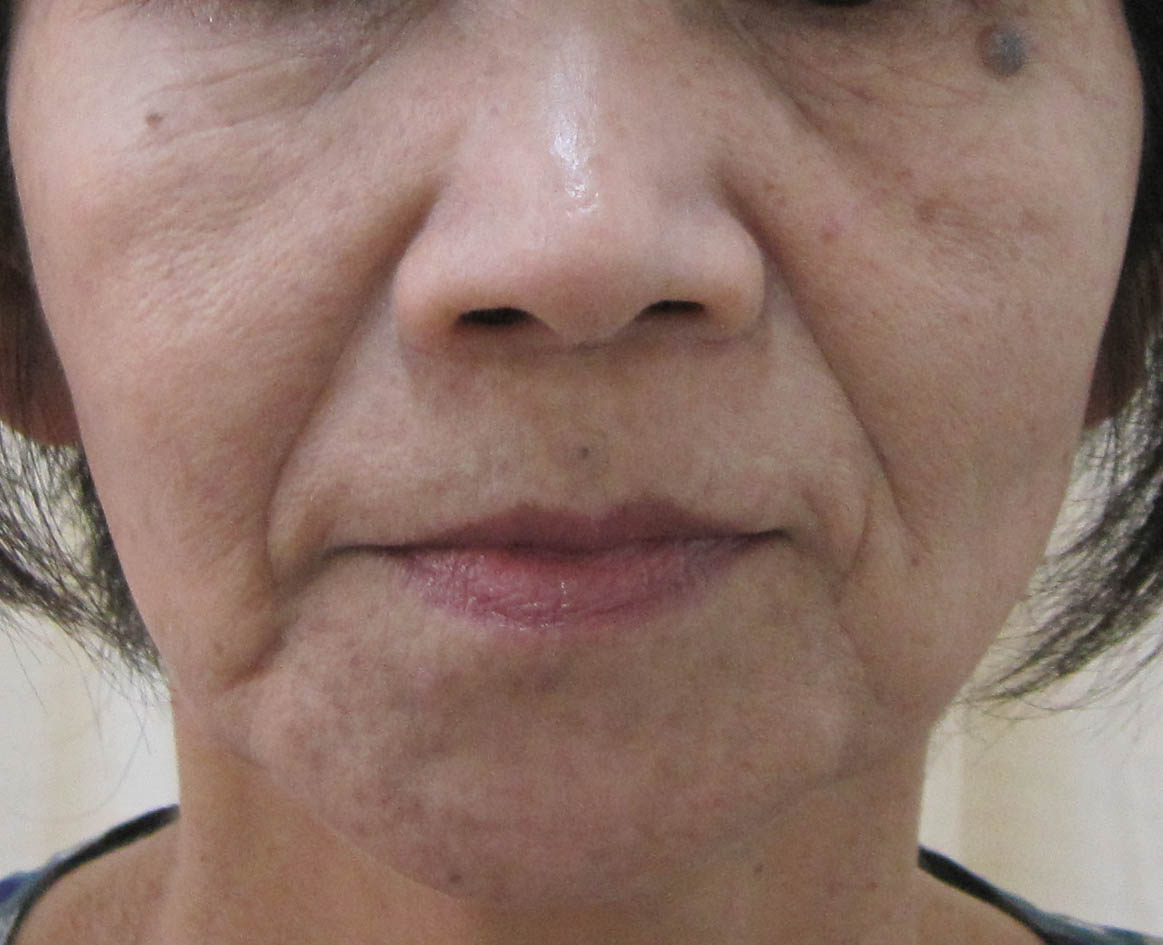 顔のたるみの治療、リフトアップ新宿高田馬場の美容皮膚科・皮膚科「山手皮膚科クリニック」