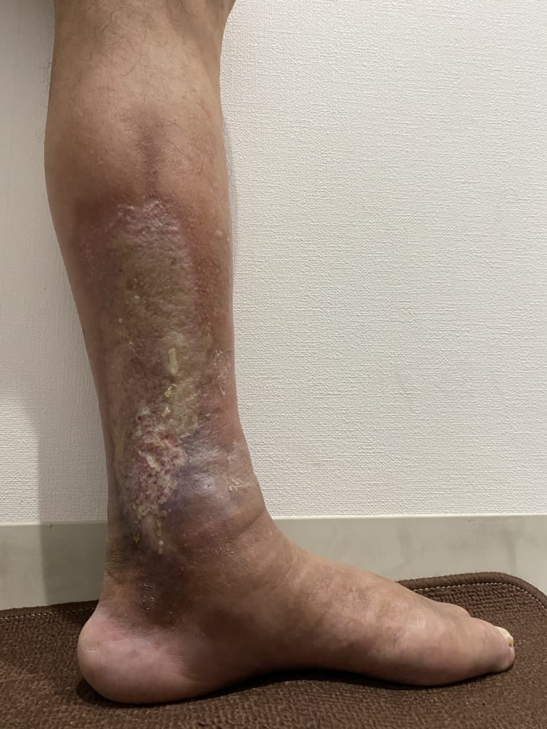 掌蹠膿疱症 しょうせきのうほうしょう ってどんな病気？掌蹠膿疱症ネット