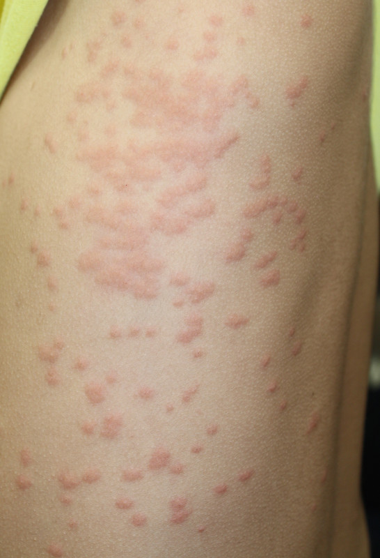 えぬくりブログ: 毛虫皮膚炎