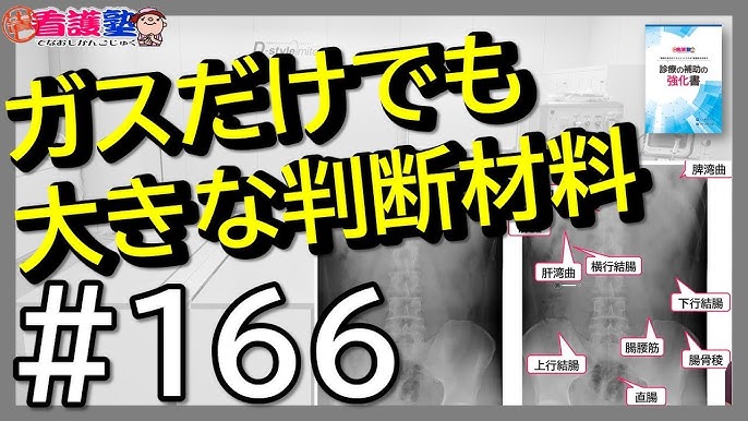 横行結腸癌に対するPincer Approach脾弯曲授動