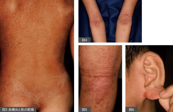 乾燥肌による湿疹 乾燥性湿疹 について解説 スキンケア・薬ひまわり医院 内科・皮膚科