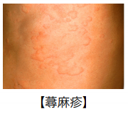 蕁麻疹 じんましんQ1 - 皮膚科Q＆A 公益社団法人日本皮膚科学会