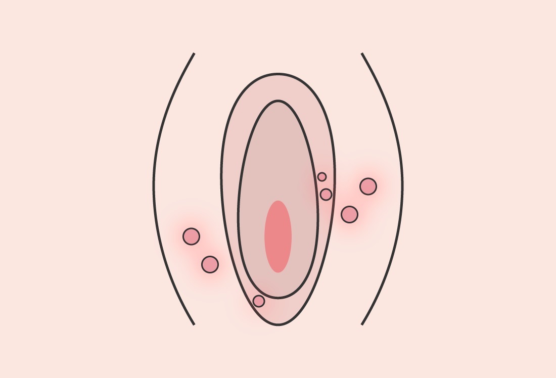 金玉 玉袋白いブツブツは何？陰嚢石灰沈着症の解説 – メンズ形成外科青山セレス&船橋中央クリニック