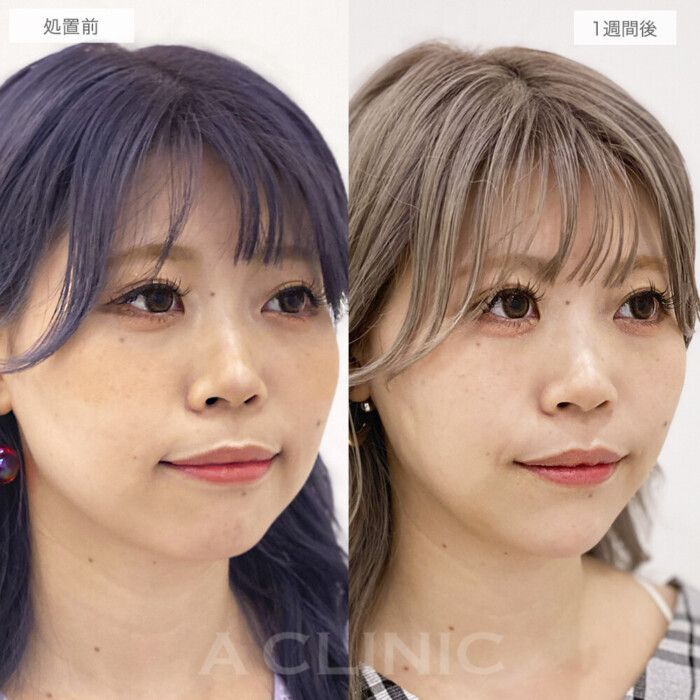 顔痩せ こんな簡単マッサージで小顔に