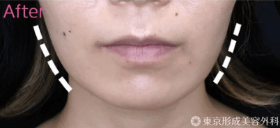 エラ取りボトックス ﻿ ﻿ エラの張ったお顔、ホームベース型の顔の輪郭を改善する施術です。﻿ ﻿ エラボトックス の治療は咬筋と呼ばれる筋肉 喰いしばった時にポコっと出っ張るエラの筋肉 にボトックスを注入することにより、筋肉を休ませエラ張りを改善し、細くしていく