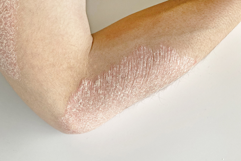 乾癬 かんせん杉沢皮膚科クリニック