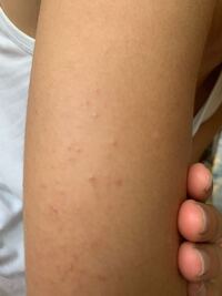 二の腕のブツブツをきれいにしたい横浜で働く美容外科院長の美容整形ここだけの話ブログ