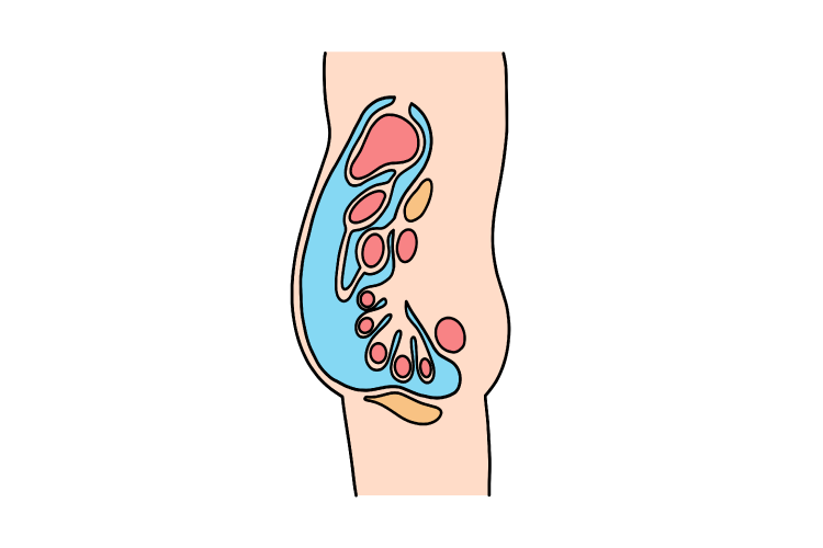 腹水 – 在宅支援なごや南ホームクリニック