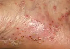 手荒れ 手湿疹・主婦湿疹 の症状や治し方神戸市須磨区の大塚皮フ科クリニック