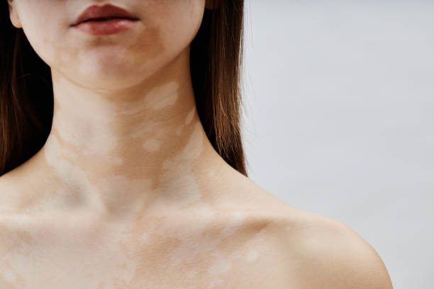 94E13色素性乾皮症 国試テコプラ