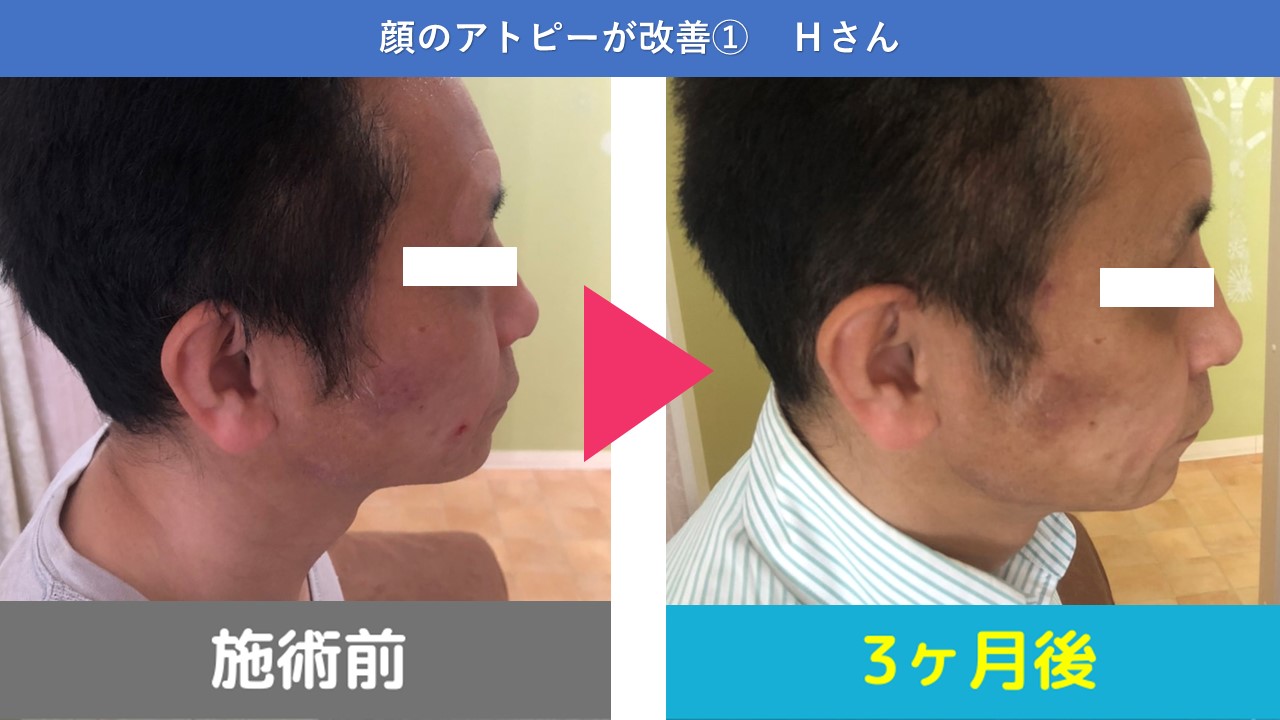 皮膚描画症 を根本から改善したい方 大阪 原因を特定する整体院 医師も推薦する技術とまり木整体院