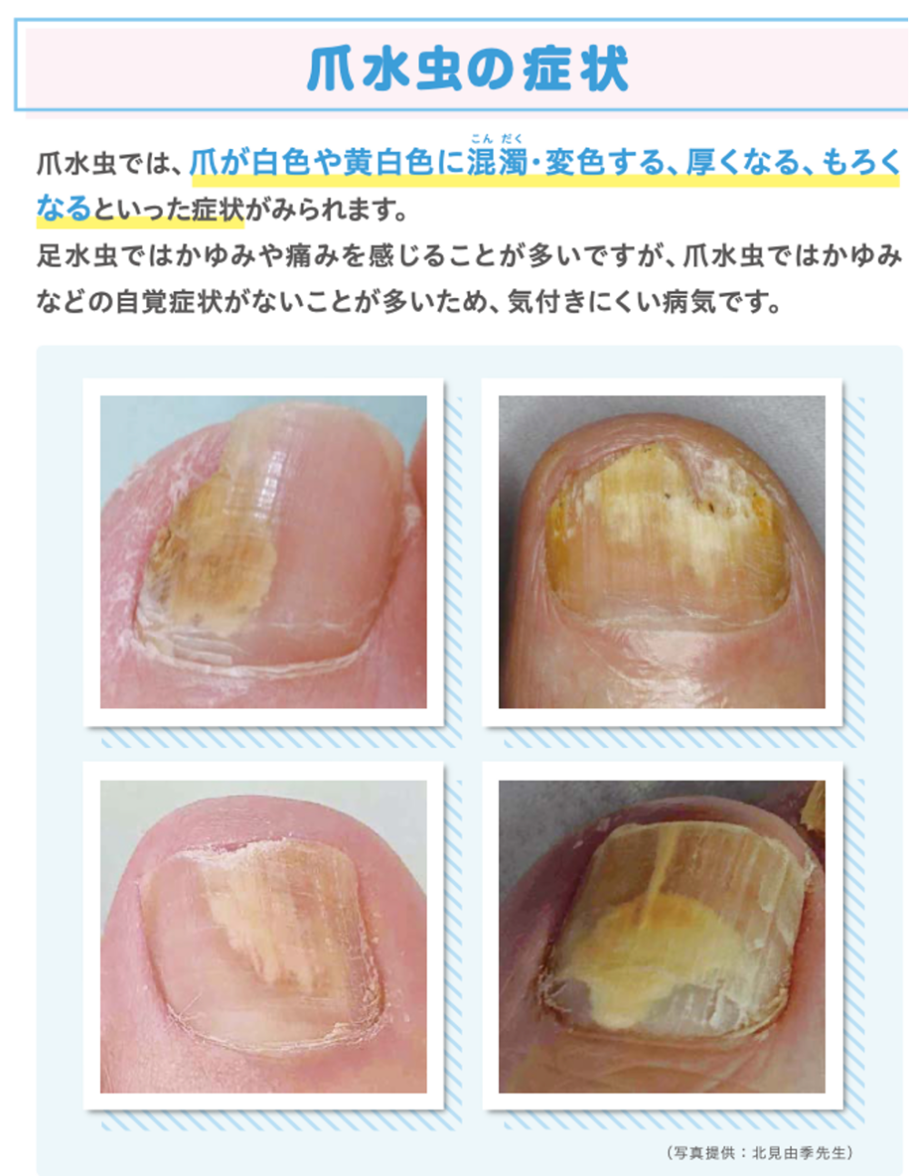 知っておきたい爪の病気やトラブル革命ネイルサロンのはあとねいる