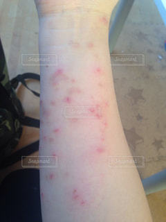 アジアの女性の腕に赤い発疹を引き起こす 、スキン背景写真素材1949828212Shutterstock