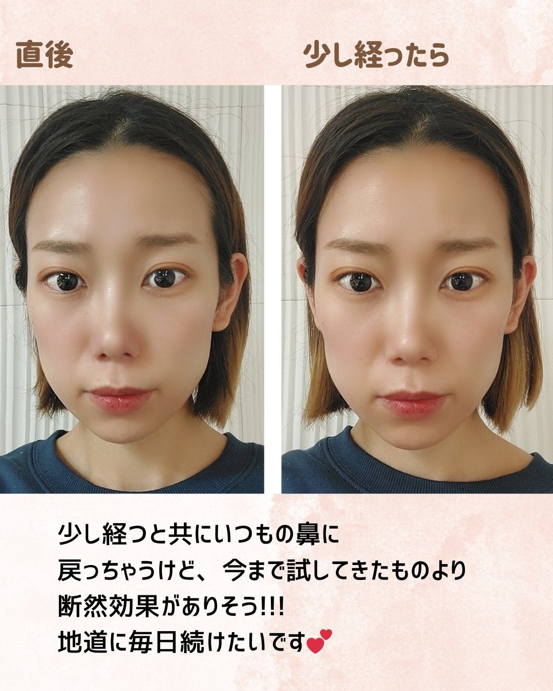 ルクセア フォーネスPRO鼻美顔器の口コミ評判は?効果・使い方を徹底解説!気になるアイテムあれやコレ