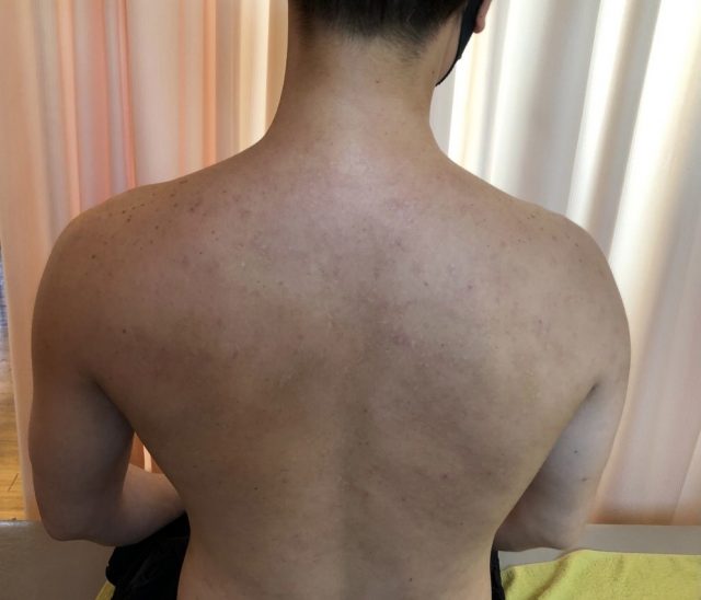 薬の効かない背中の湿疹川崎市多摩区のアトピー専門整体「英気治療院」