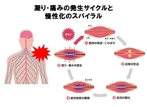 肩こりや腰痛の原因 猫背を直す3つのポイント - 日本経済新聞