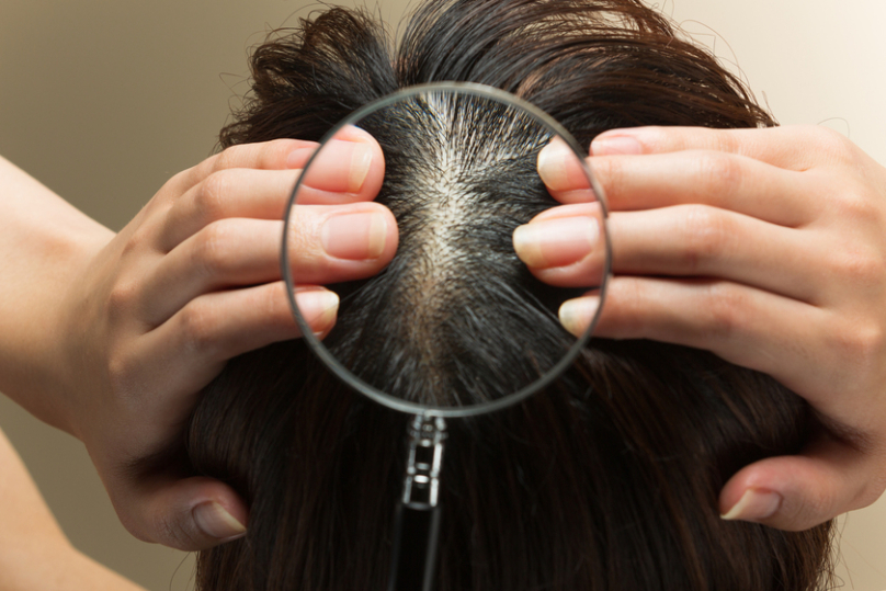 頭皮ニキビ – room.南森町スタッフブログ