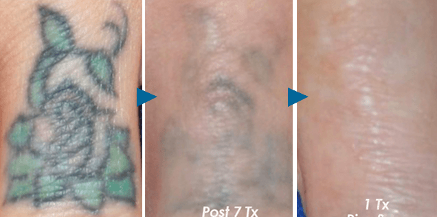 3年前に憧れの彫り師さんに複数タトゥーを入れてもらったものの、看護学生になり実習があるためタトゥーを消さないと行けなくなった患者様です👩‍🎓タトゥーの部分に瘢痕で凸凹があったことと、できるだけ早く消したいとのご希望でピコレーザーと、傷をなじませるピコ