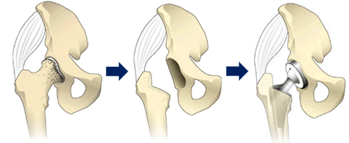 人工骨頭置換術後のリハビリ 大腿骨頸部骨折千葉県 自費リハビリ施設 トータルリハビリテーション 「トリア」
