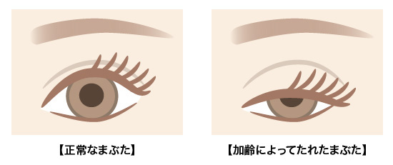 眼瞼下垂とは？ - オキュロフェイシャルクリニック大阪