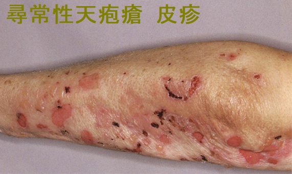 糖尿病とかゆみの関係は？皮膚に生じる主な症状や予防のポイントについて解説 - 府中すみよしクリニック