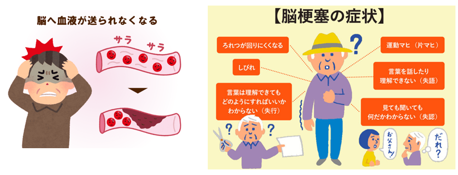 脳出血と脳梗塞の違いって何？その症状やリスクを徹底解説脳梗塞・脊髄損傷後遺症の幹細胞治療ニューロテックメディカル