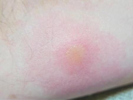 虫刺され』の症状・治療法 症例画像 田辺三菱製薬ヒフノコトサイト