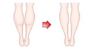 すねが太い 大根足になる理由は、浮き指だった
