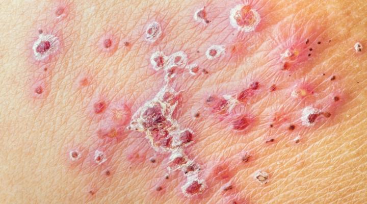 帯状疱疹 浅田秀夫教授川村内科診療所様