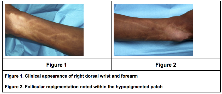 老人性色素斑の治療を皮膚科専門医が症例写真で解説