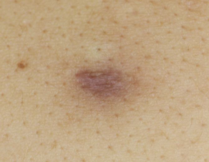 粉瘤、線維腫、脂肪腫やべ形成外科クリニック