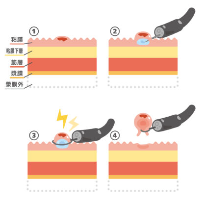 大腸ポリープ切除について尼崎内視鏡・おおにし内科 旧：山口内科整形外科