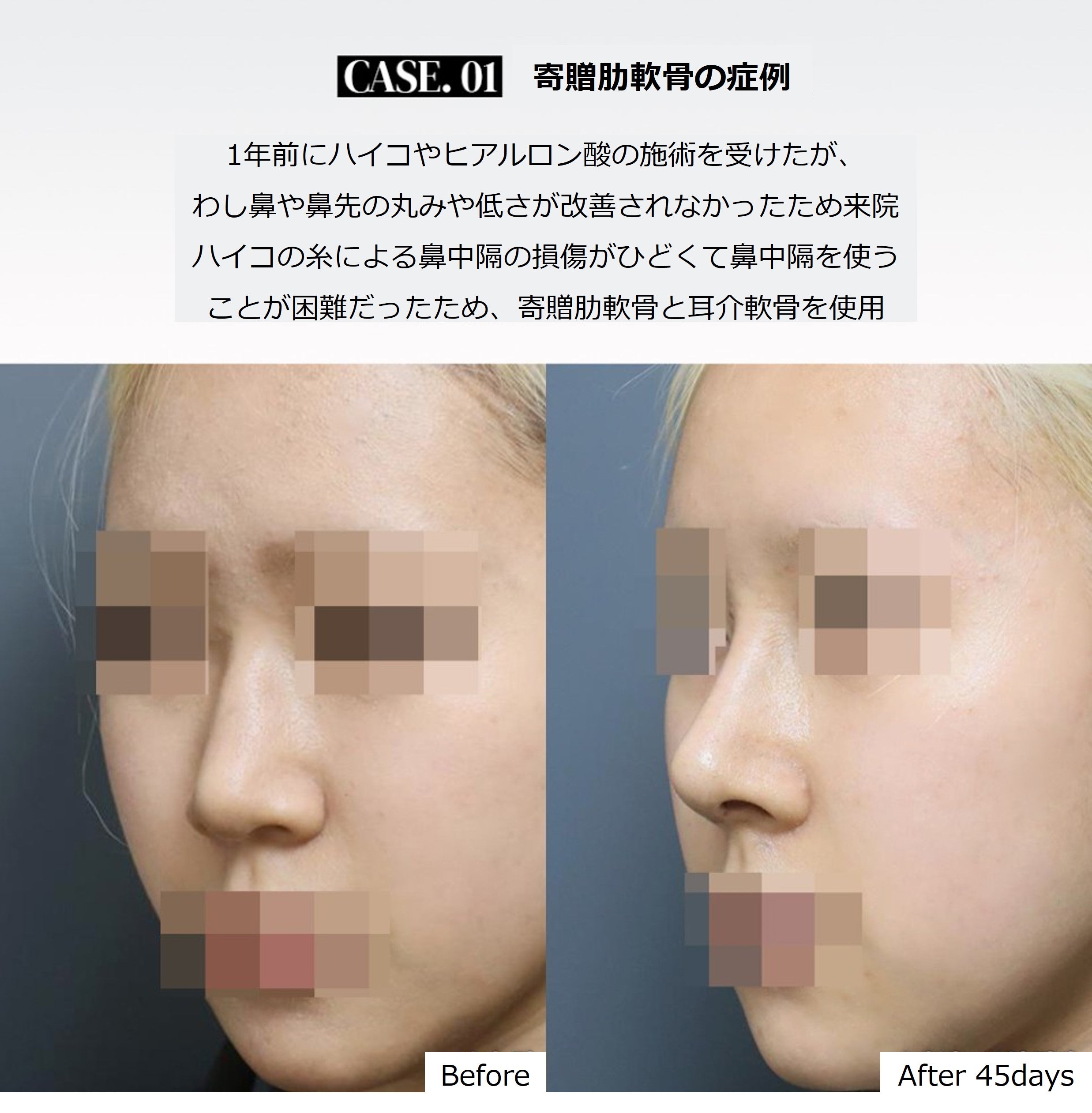 自家組織移植術 耳介軟骨・筋膜・肋軟骨・真皮鼻の整形ならジョウクリニック