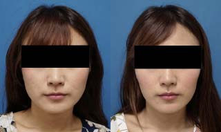 顔が大きく見える原因と顔を小さくする方法輪郭形成・小顔整形 コラム池袋の小顔整形・顔痩せ・輪郭整形みずほクリニック