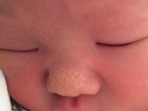 これって手足口病？写真でセルフチェック対処方法と注意点も解説 - ことびあクリニック恵比寿院恵比寿・広尾の小児科土日祝も診療