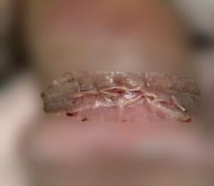 尖圭コンジローマの検査と治療 男女別症状や感染経路、感染率は？ 天神マイケアクリニック