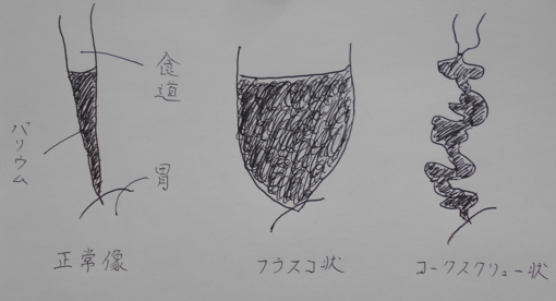 胃がん発見の為の胃カメラ検査の有用性
