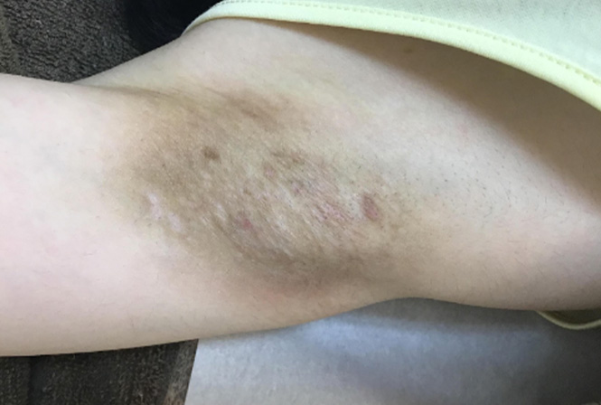 薄着になる前に 身体の黒ずみ治療しませんか🙋‍♀️ 脇の黒ずみにレーザートーニングを 1ヶ月に1回、合計5回行った方の症例です🌟 黒ずみがなくなり、肌の色が戻ってきました‼️紫外線が強くなる前、今の時期からの 治療がオススメです😘黒ずみインティマレーザー