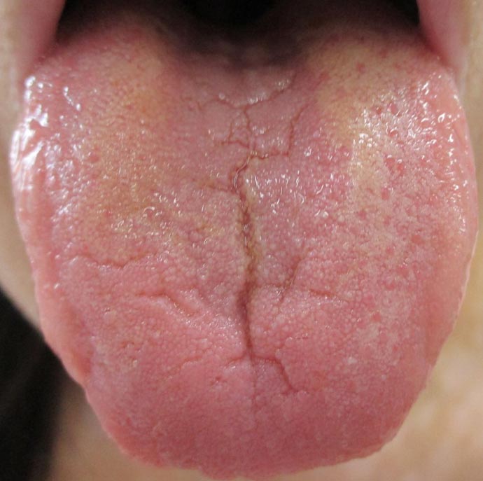 石豆。舌は健康のバロメーター三越前駅小伝馬町歯科 ハルデンタルオフィス