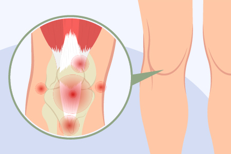 脊柱管狭窄症の予防法：日常生活でできることILC国際腰痛クリニック 公式サイト