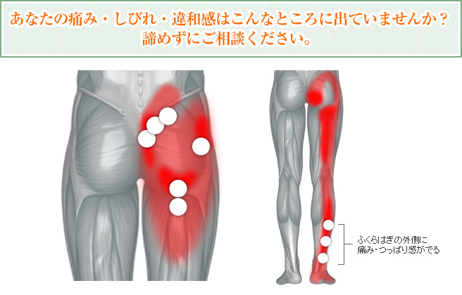 おしりの横の筋肉が痛い原因とは？考えられる疾患と対処法を解説「さかぐち整骨院 -枚方市-」枚方市で口コミ評価NO.1