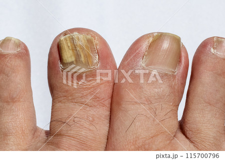 写真付き！足の爪の変形や変色の理由って？巻き爪 、爪甲鉤彎症、爪白癬 症状と原因、治療、予防法1 1介護ポストセブン